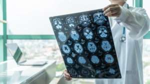 How Common Are Clearwater Brain Injuries?