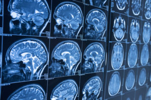 Understanding the Potential Severity of Brain Injuries