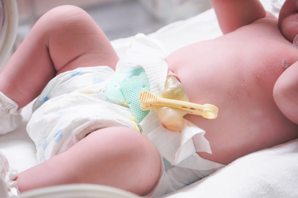 Umbilical Cord Prolapse Birth Injury Claims